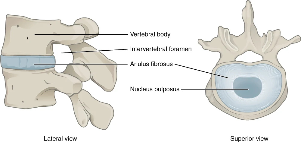 Anatomische illustratie van een tussenwervelschijf tussen twee wervels, met de vezelring en de zachte kern